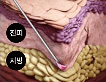 마이크로 니들
